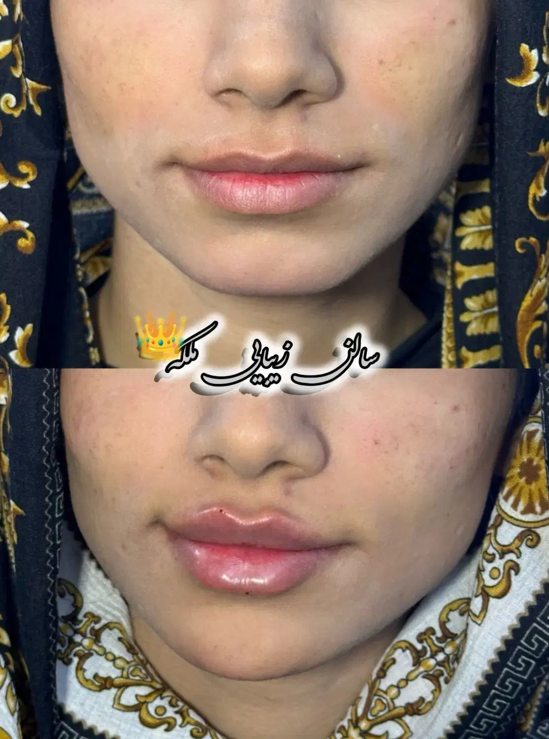 فیلر و بوتاکس ....|خدمات آرایشگری و زیبایی|زابل, |دیوار