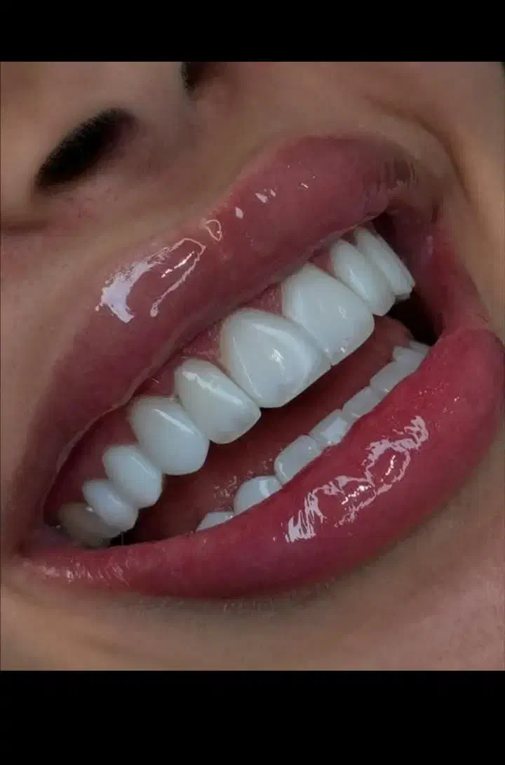 دندانپزشکی زیبایی روکش کامپوزیت عصبکشی ترمیم دندان|خدمات آرایشگری و زیبایی|تبریز, |دیوار