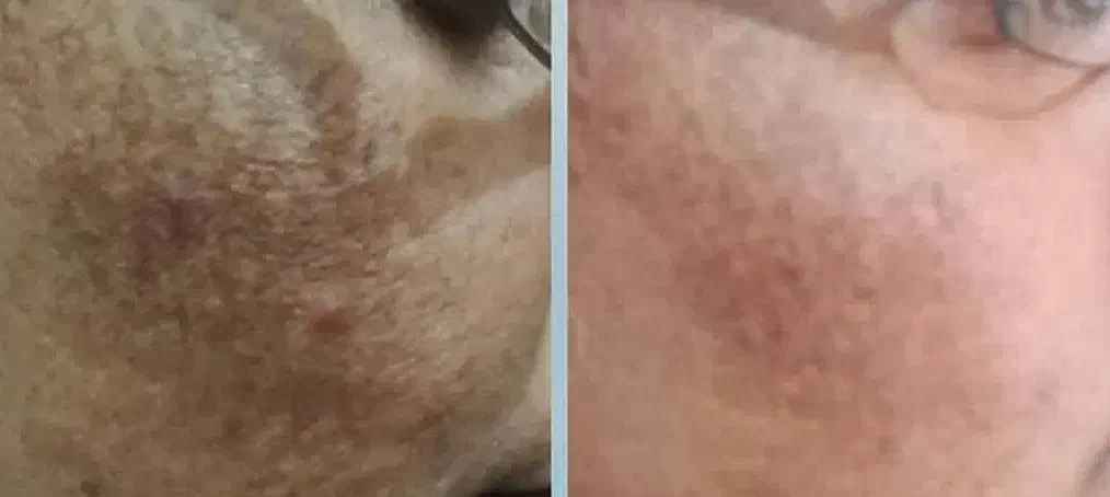 کرم روشن سازی و از بین برنده ی لکو جای جوش|آرایشی، بهداشتی، درمانی|چهارباغ, |دیوار