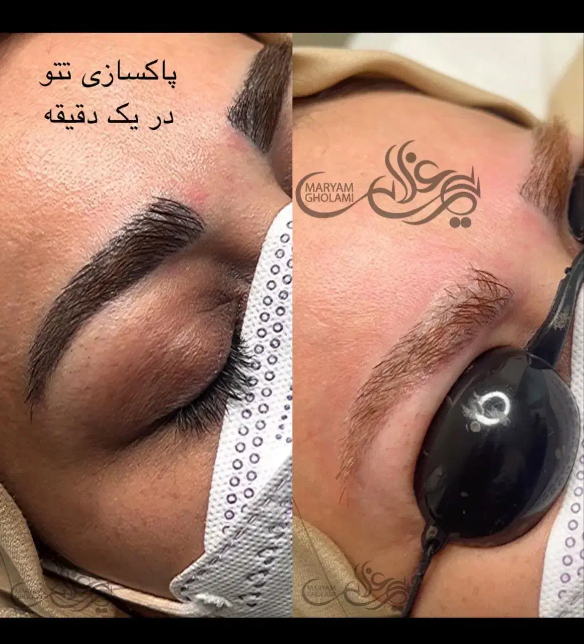 جشنواره تخفیفی ریموو تتو با لیزر|خدمات آرایشگری و زیبایی|تهران, سعادت‌آباد|دیوار