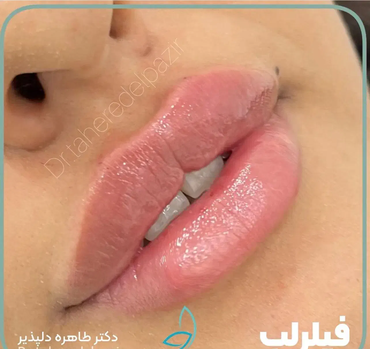 خالبرداری،حذف تاتو با لیزر و تمامی تزریقات زیبایی|خدمات آرایشگری و زیبایی|شیراز, گلدشت معالی‌آباد|دیوار