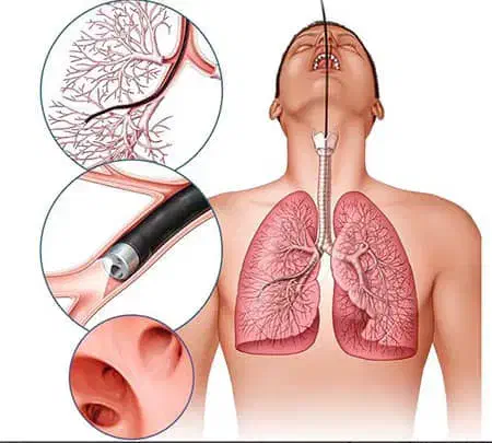 بهبود خلط پشت گلو|آرایشی، بهداشتی، درمانی|گنبد کاووس, |دیوار