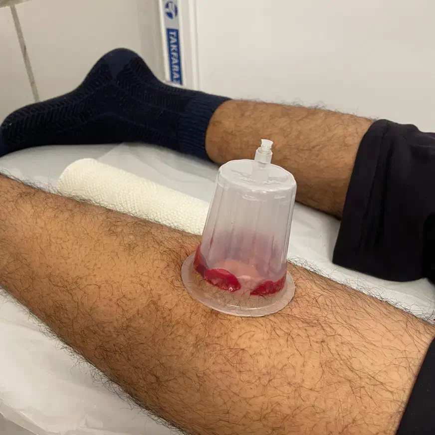 فصد پیشانی، حجامت، طب سوزنی|خدمات آرایشگری و زیبایی|شیراز, سینما سعدی|دیوار