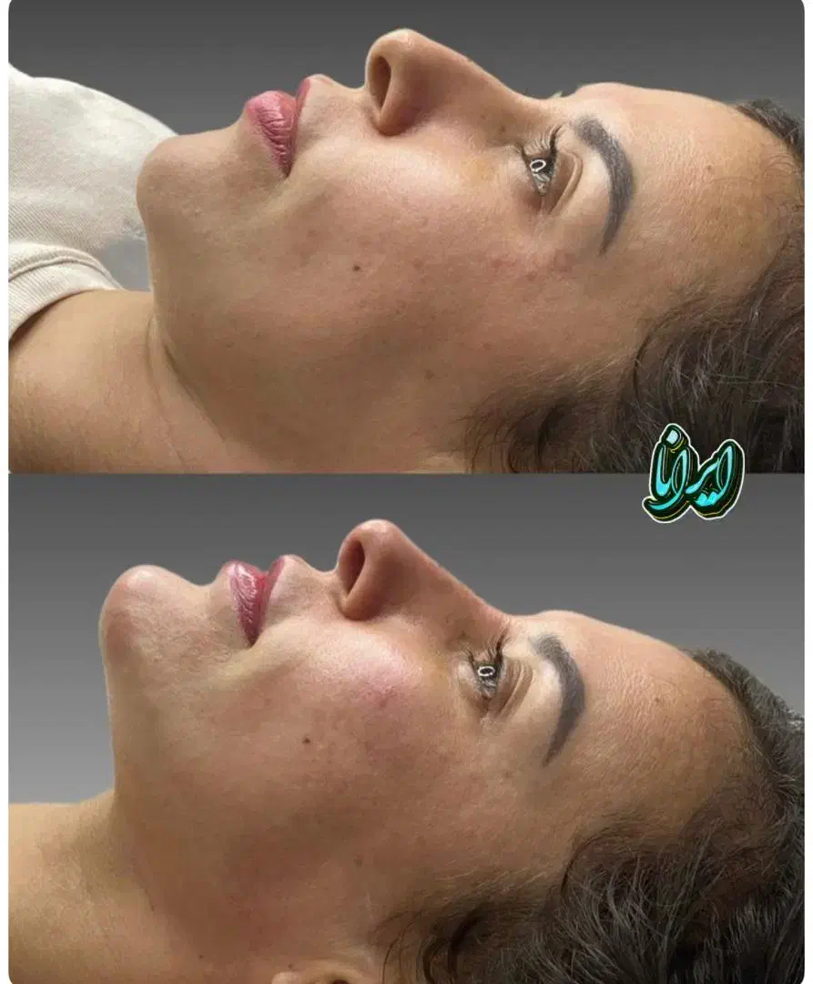 ساکشن غبغب توسط جراح (کلنیک ایرانا)|خدمات آرایشگری و زیبایی|یاسوج, |دیوار