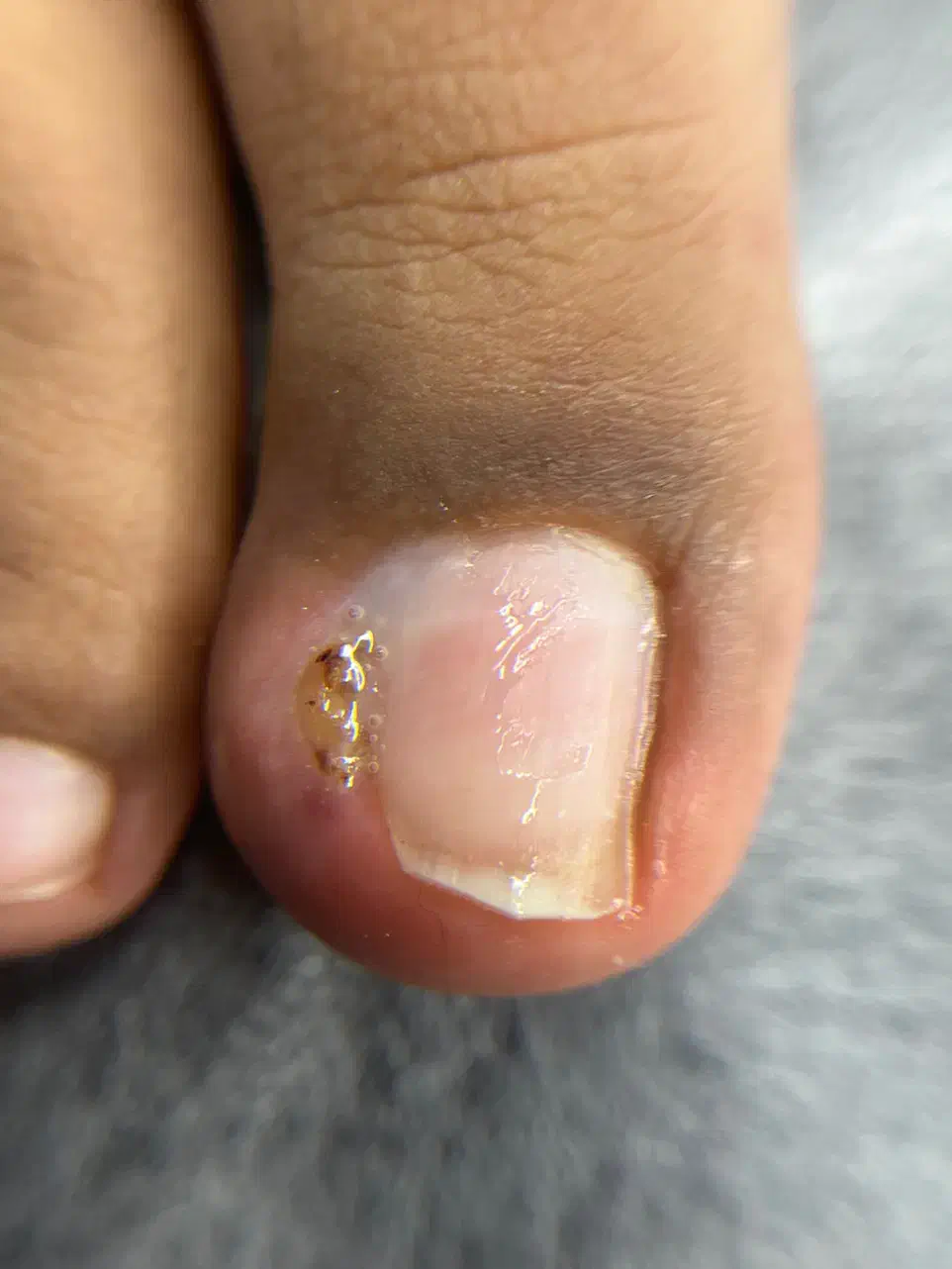 فرورفتگی ناخن توگوشت|آرایشی، بهداشتی، درمانی|انار, |دیوار