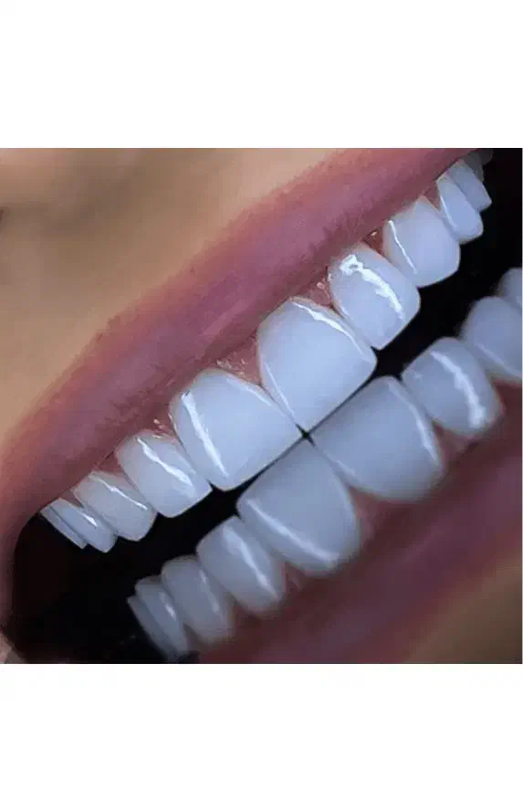 دندانپزشکی کامپوزیت ونیر فقط 9میلیون  اقساطی|خدمات آرایشگری و زیبایی|ارومیه, |دیوار