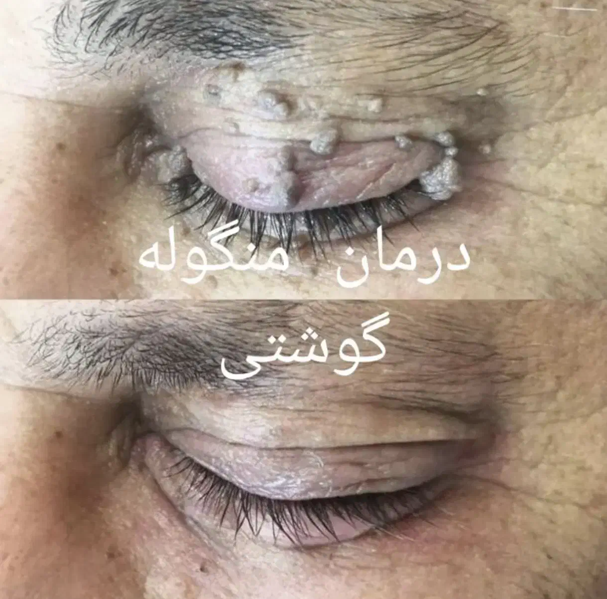 خال برداری ،میخچه زگیل وتمامی زائده هاباقطره گیاهی|خدمات آرایشگری و زیبایی|اصفهان, شفق|دیوار