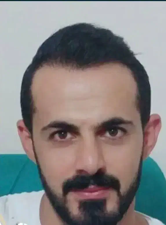 کاشت مو با جدید ترین روش بدون جراحی و درد|خدمات آرایشگری و زیبایی|اردبیل, |دیوار