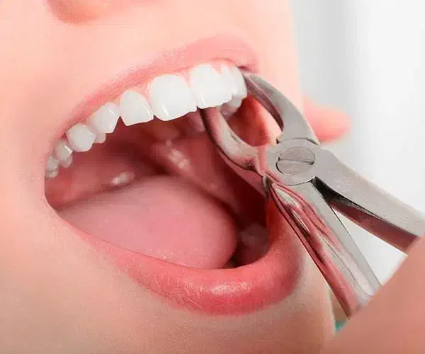 کشیدن دندان زیر نظر متخصص|خدمات آرایشگری و زیبایی|ساری, |دیوار