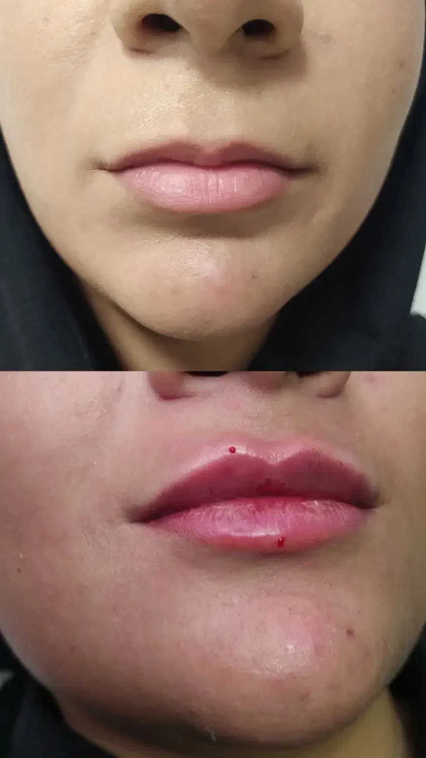 ژل، فیلر لب ۵۰۰،آنزیم ۳۵۰،زاویه ،بوتاکس۴۵۰|خدمات آرایشگری و زیبایی|قم, تولید دارو و یخچال|دیوار