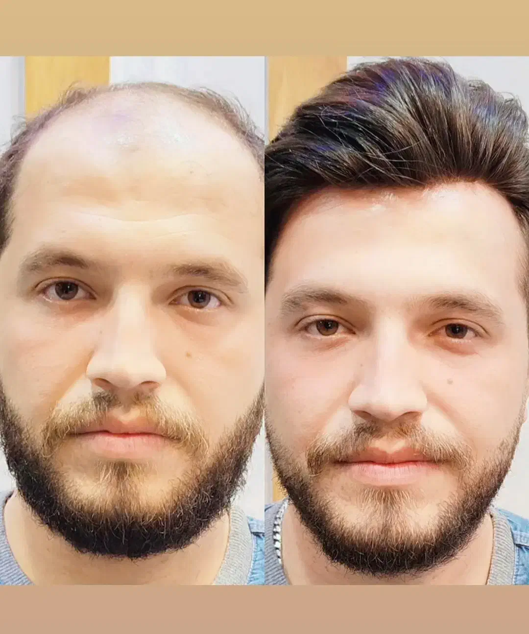 پروتز مو|آرایشی، بهداشتی، درمانی|تهران, سلسبیل جنوبی|دیوار