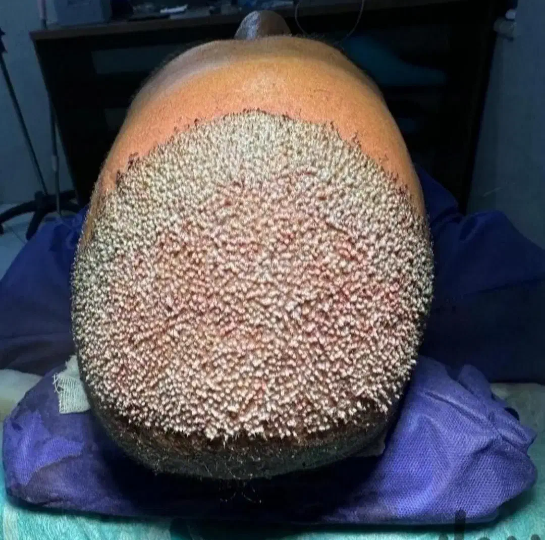 کاشت مو طبیعی له روش میکروfit وsut|خدمات آرایشگری و زیبایی|رامشیر, |دیوار