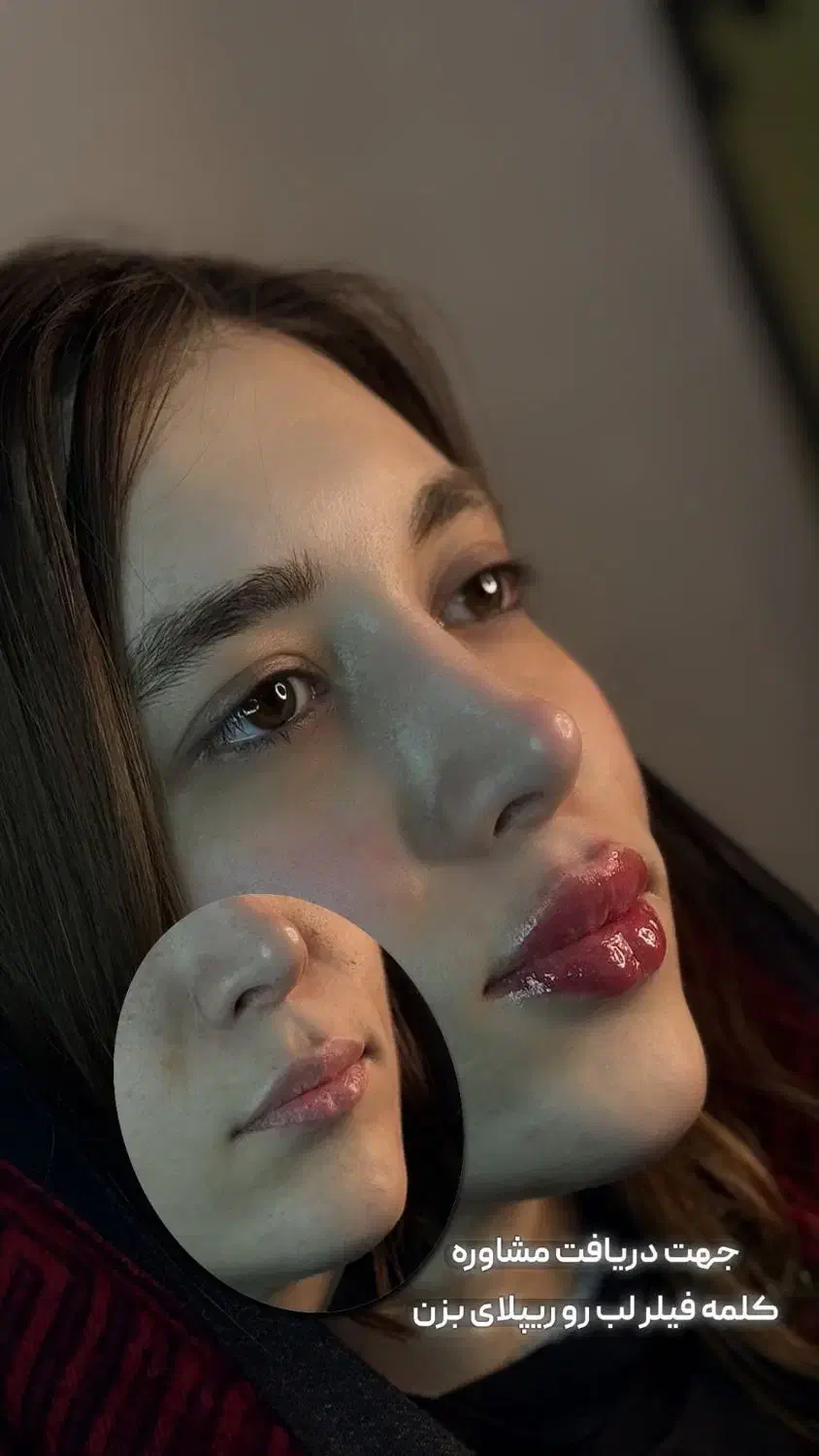 تزریق فیلر لب روسی|آرایشگاه و سالنهای زیبایی|تهران, صادقیه|دیوار