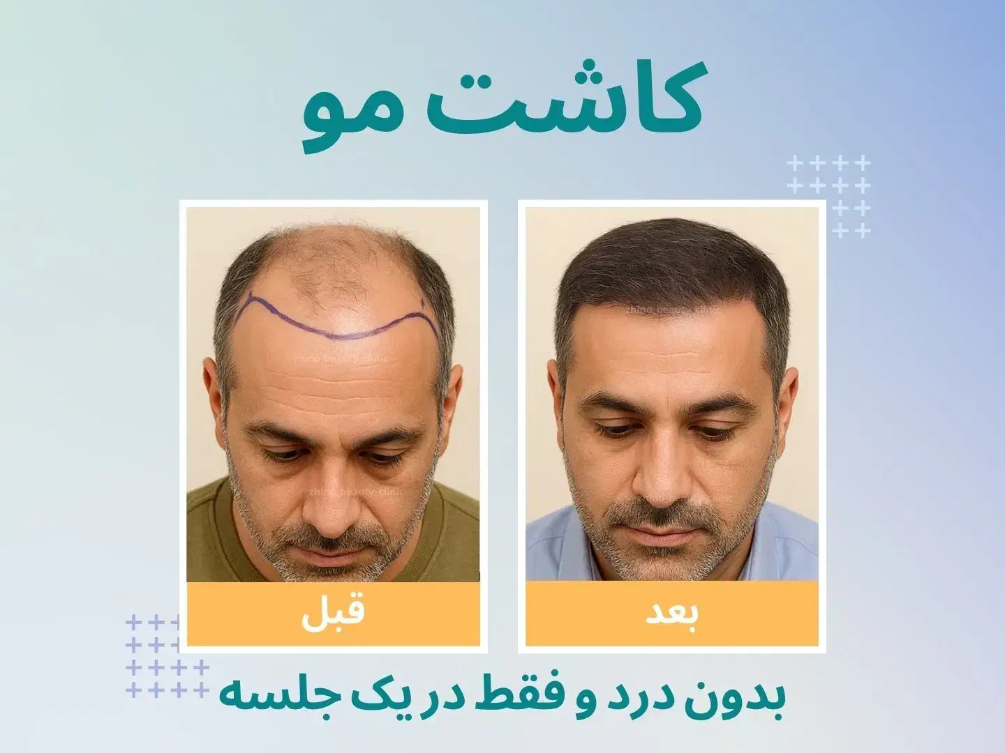 کاشت مو/ فول تراکم/ متد FIT/ بدون نیاز به جراحی|خدمات آرایشگری و زیبایی|تهران, دروس|دیوار