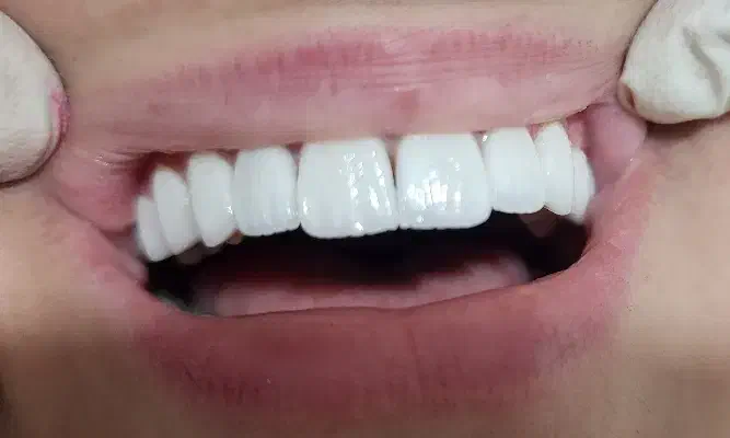 دهان و دندان(زیبایی ،لمینیت|خدمات آرایشگری و زیبایی|بروجرد, |دیوار