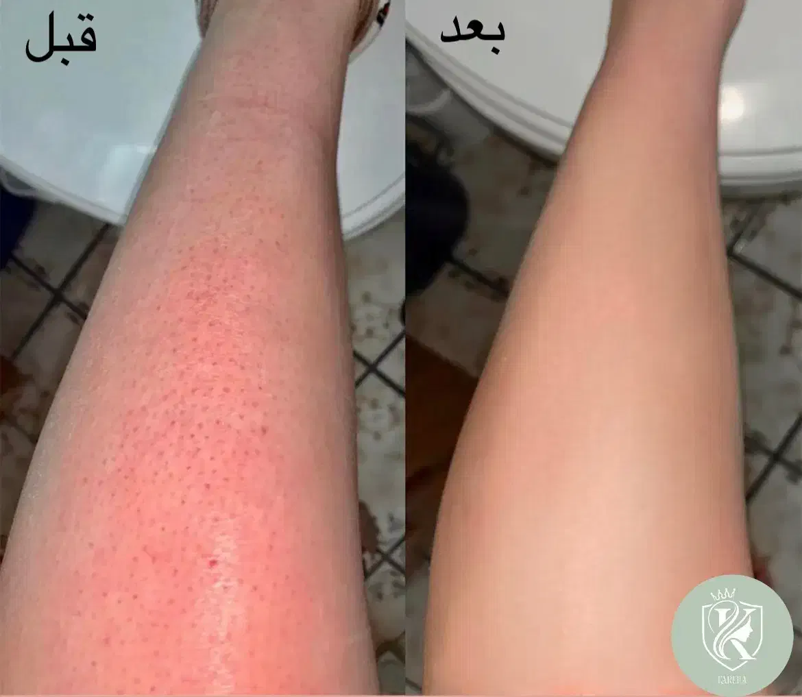 لیزر موهای زائد با آخرین تکنولوژی دستگاه|خدمات آرایشگری و زیبایی|تهران, زعفرانیه|دیوار