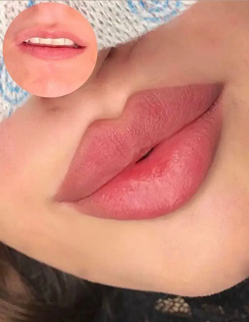 تزریق ژل بوتاکس فیلر لیزرجوانساز مزو مطب زیبایی|خدمات آرایشگری و زیبایی|تبریز, |دیوار