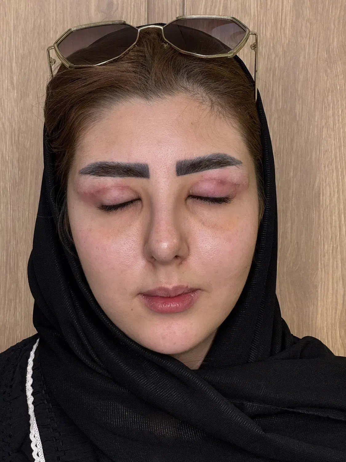 تزریق ژل بوتاکس هایفوتراپی بلفاروپلاستی توسط پزشک|خدمات آرایشگری و زیبایی|تبریز, |دیوار