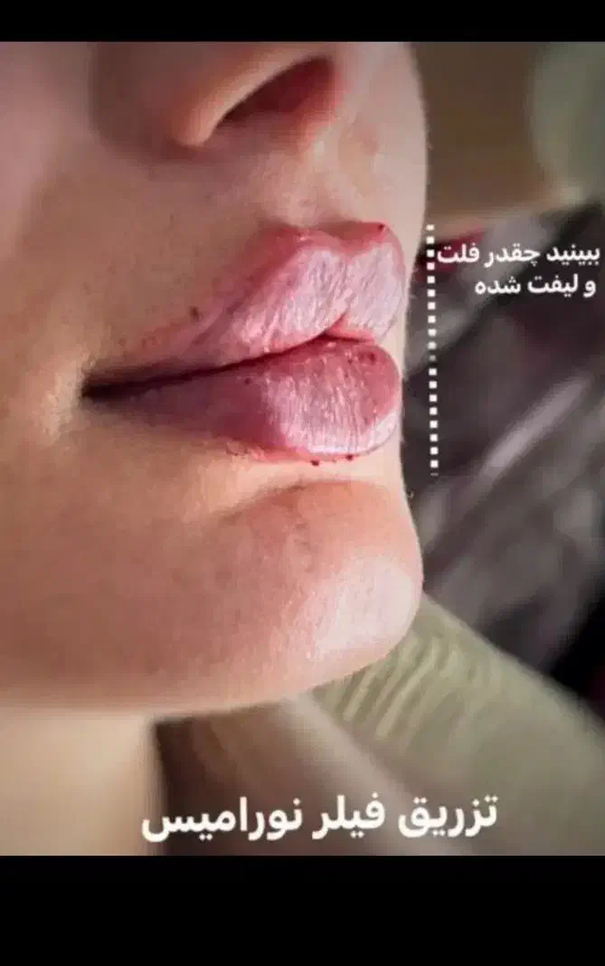 فیلر بادی(هیپ دیپ،بیکینی،ساق)محصولات سفیدکردن پوست|خدمات آرایشگری و زیبایی|بندر ماهشهر, |دیوار