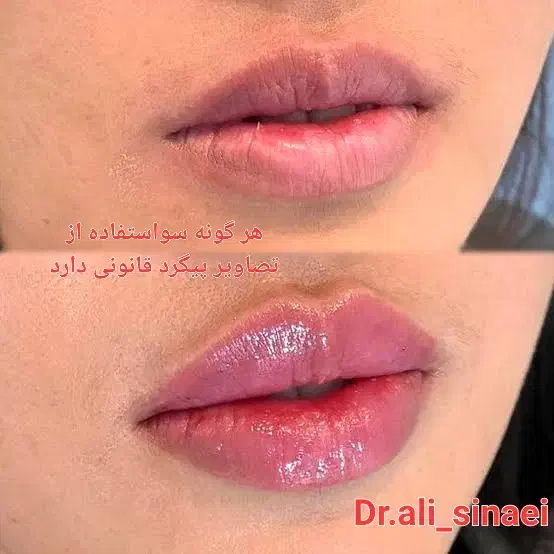 جشنواره تزریق فیلر و ژل و بوتاکس در قلب پزشکی مشهد|خدمات آرایشگری و زیبایی|مشهد, احمدآباد|دیوار