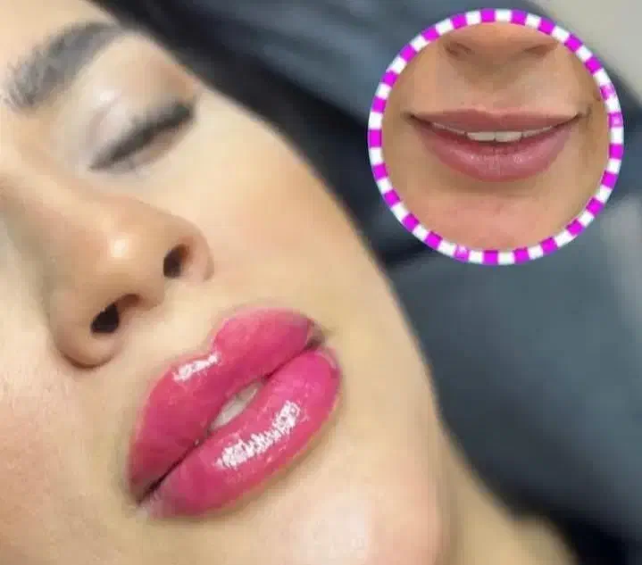 تزریق بوتاکس فیلر انزیم prp مزوتراپی جوانسازی|خدمات آرایشگری و زیبایی|کرمانشاه, |دیوار