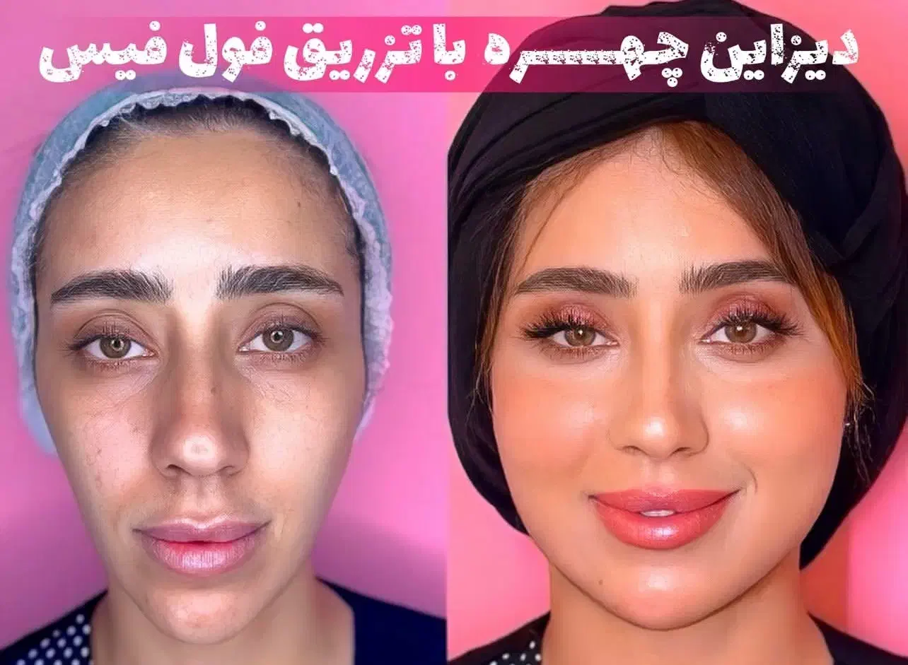 بوتاکس پیشانی،خط اخم رایگان شد توسط پزشک|خدمات آرایشگری و زیبایی|کاشان, بهشتی|دیوار