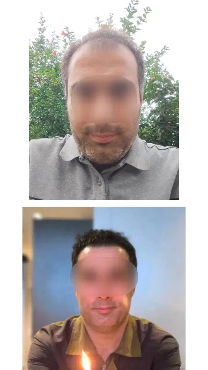 جشنواره ویژه کاشت مو و ابرو|خدمات آرایشگری و زیبایی|رشت, بوسار|دیوار