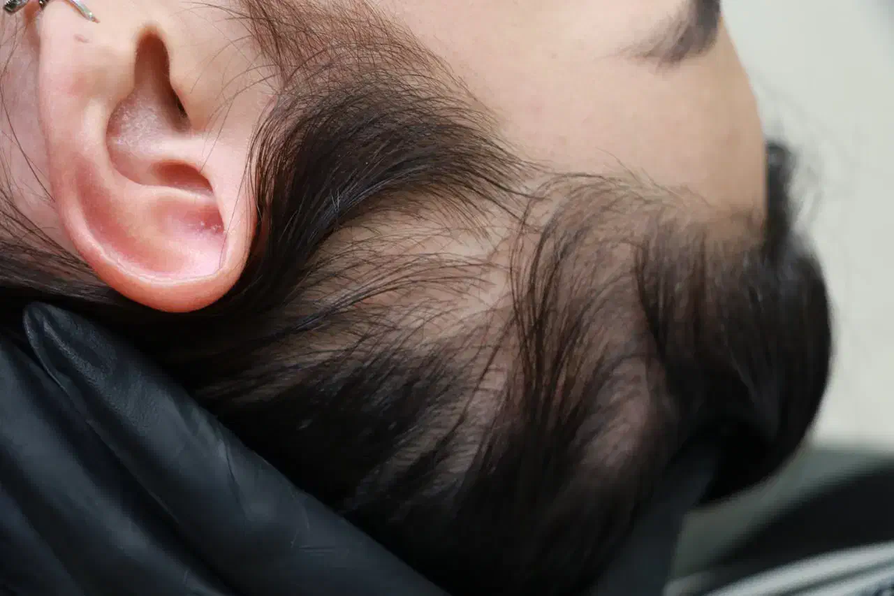 رفع کم پشتی مو با میکرو اسکالپ سر|خدمات آرایشگری و زیبایی|نسیم‌شهر, |دیوار