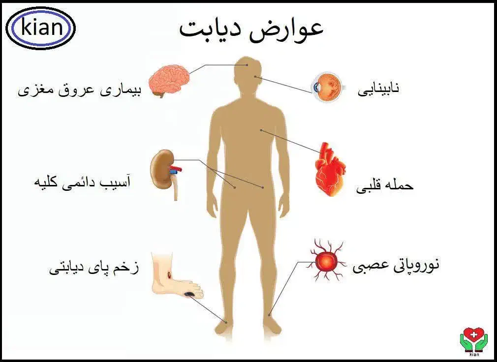 دیابت تمام شد کاملا گیاهی|خوردنی و آشامیدنی|شیراز, گلکوب|دیوار