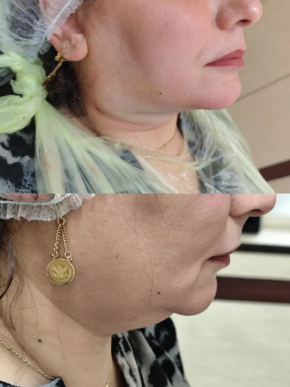 آف تخلیه غبغب وپی ارپی|خدمات آرایشگری و زیبایی|خرمشهر, |دیوار