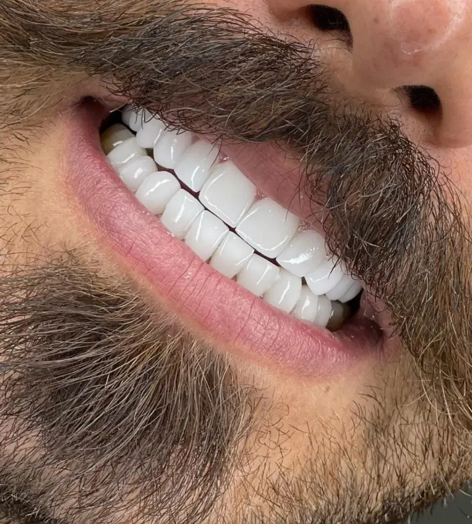 کامپوزیت دندان|خدمات آرایشگری و زیبایی|بوشهر, |دیوار