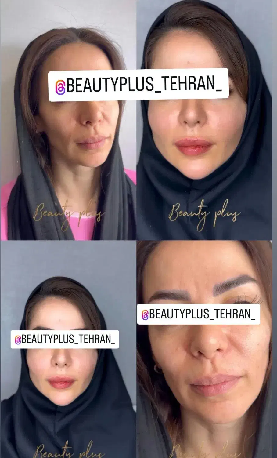 ساکشن غبغب وتزریق چربی بصورت و هرناحیه ازبدن درمطب|خدمات آرایشگری و زیبایی|قم, زنبیل آباد|دیوار