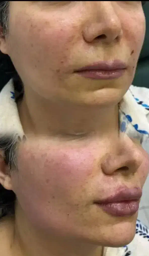 تخفیف فوق العاده خدمات ژل و بوتاکس در مطب|خدمات آرایشگری و زیبایی|شاهینشهر, بوستان حافظ|دیوار