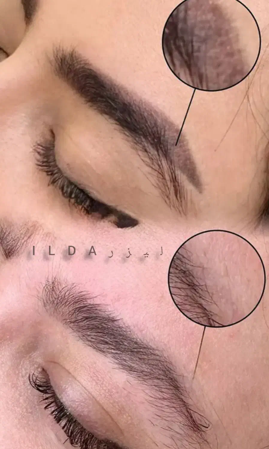 حذف تاتو و خالکوبی با لیزر کیوسوئیچ|خدمات آرایشگری و زیبایی|محمدشهر, محمدشهر|دیوار