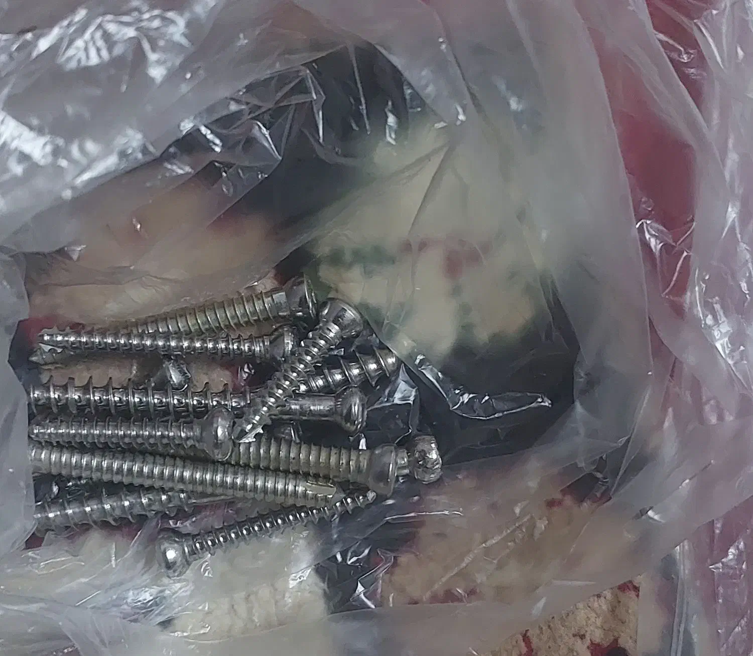 پلاتین نقره برای شکستگی|آرایشی، بهداشتی، درمانی|یاسوج, |دیوار