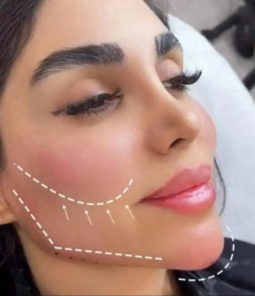 جشنواره ی ۵۰ درصد آف ویژه ی ژل بوتاکس توسط پزشک|خدمات آرایشگری و زیبایی|کرمانشاه, |دیوار