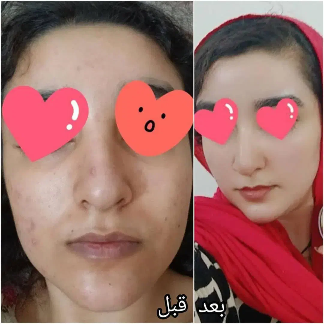 ضدلک تضمینی کاریزما|آرایشی، بهداشتی، درمانی|دهدشت, |دیوار