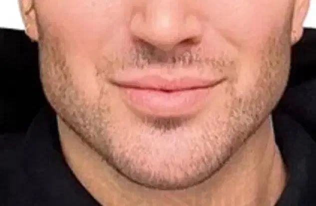 آفر زاویه سازی صورت آقایان و بانوان با تزریق فیلر|خدمات آرایشگری و زیبایی|دوگنبدان, |دیوار