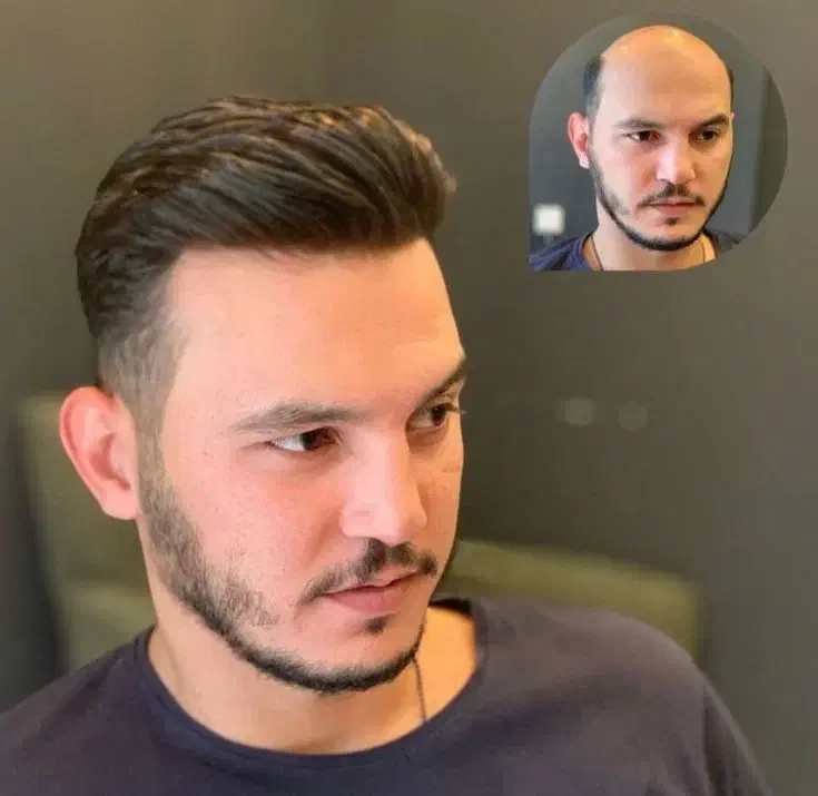 کاشت موی تضمینی با خط رویش 100٪ طبیعی|خدمات آرایشگری و زیبایی|شهرکرد, |دیوار