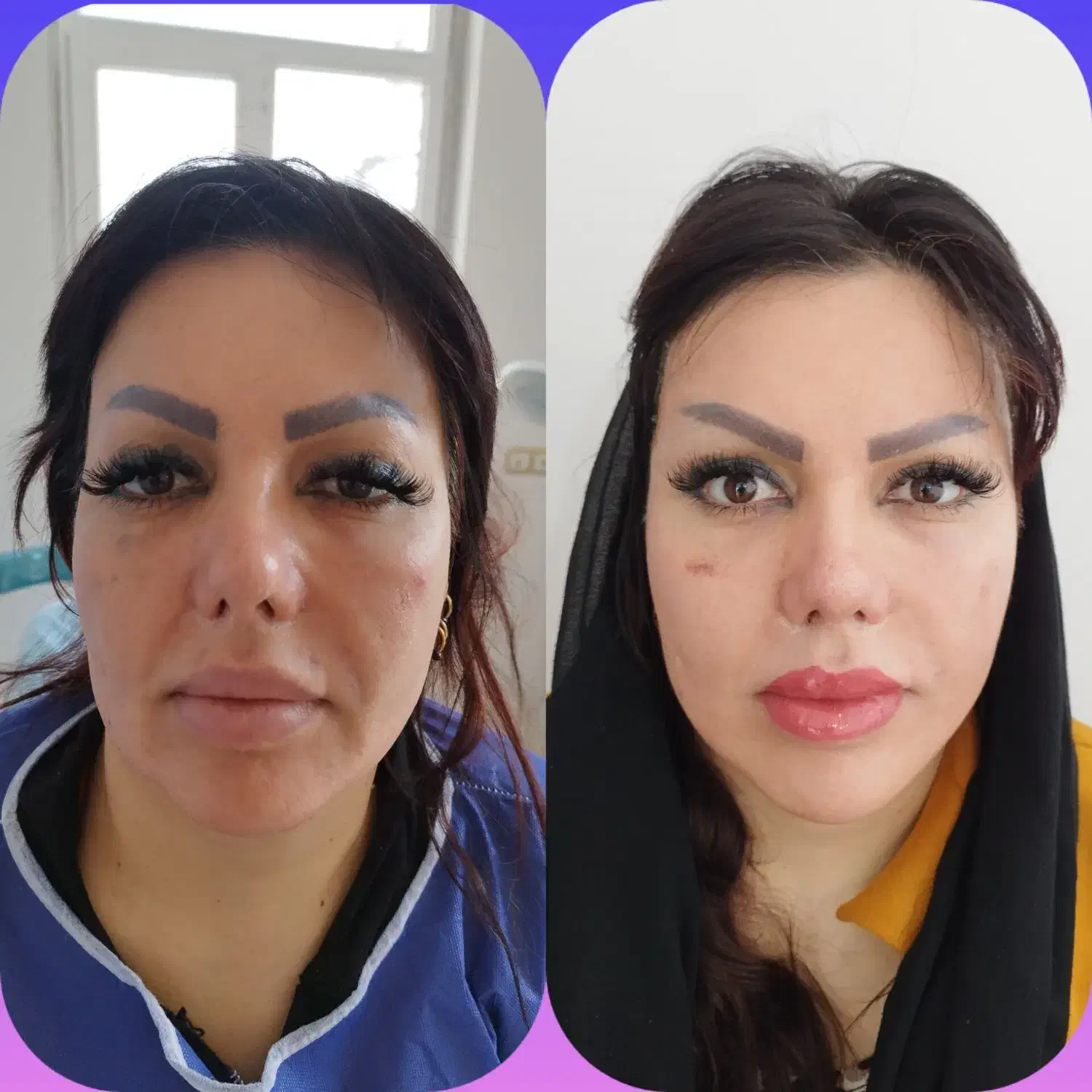 لیفت شقیقه وگونه با جراحی|خدمات آرایشگری و زیبایی|بوکان, |دیوار