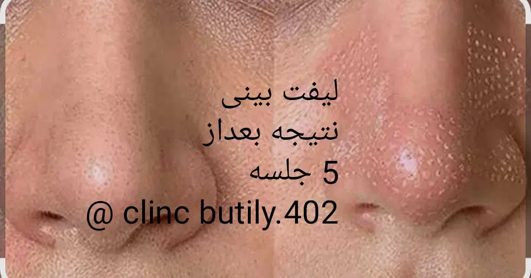 لیزرمیکرو پلاسمالیفت زیبایی/ بینی شیک/بلفاروپلاستی|خدمات آرایشگری و زیبایی|کرمانشاه, |دیوار