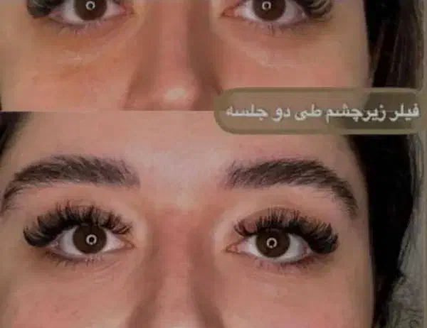 تزریق ژل و بوتاکس تضمینی|خدمات آرایشگری و زیبایی|اهواز, نادری|دیوار
