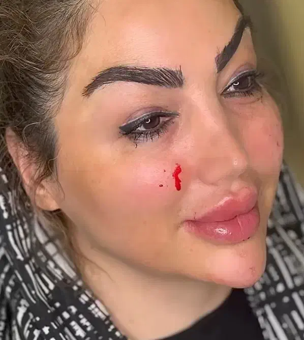 تزریق ژل بوتاکس و چربی شکم پهلو|خدمات آرایشگری و زیبایی|کرمانشاه, |دیوار