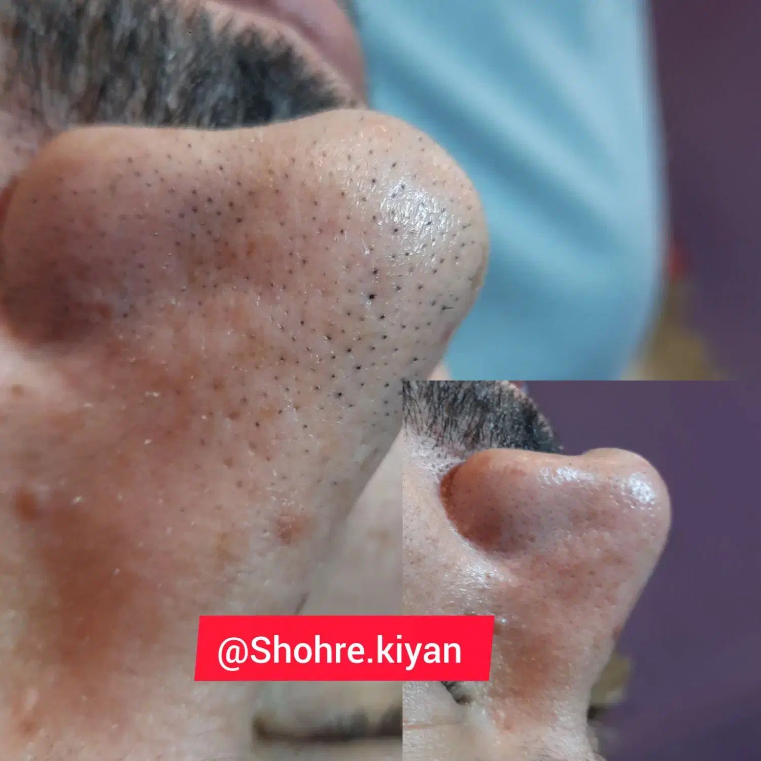 پاکسازی پوست|خدمات آرایشگری و زیبایی|اصفهان, شهرک سلامت|دیوار