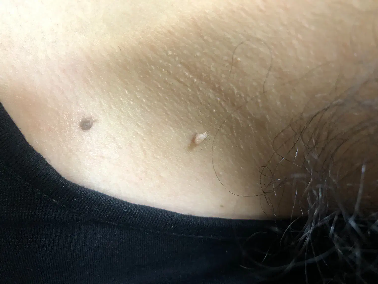 حذف انواع خال (گوشتی،سطحی،زیگیل)|خدمات آرایشگری و زیبایی|کاشان, فاز ۲ ناجی آباد|دیوار