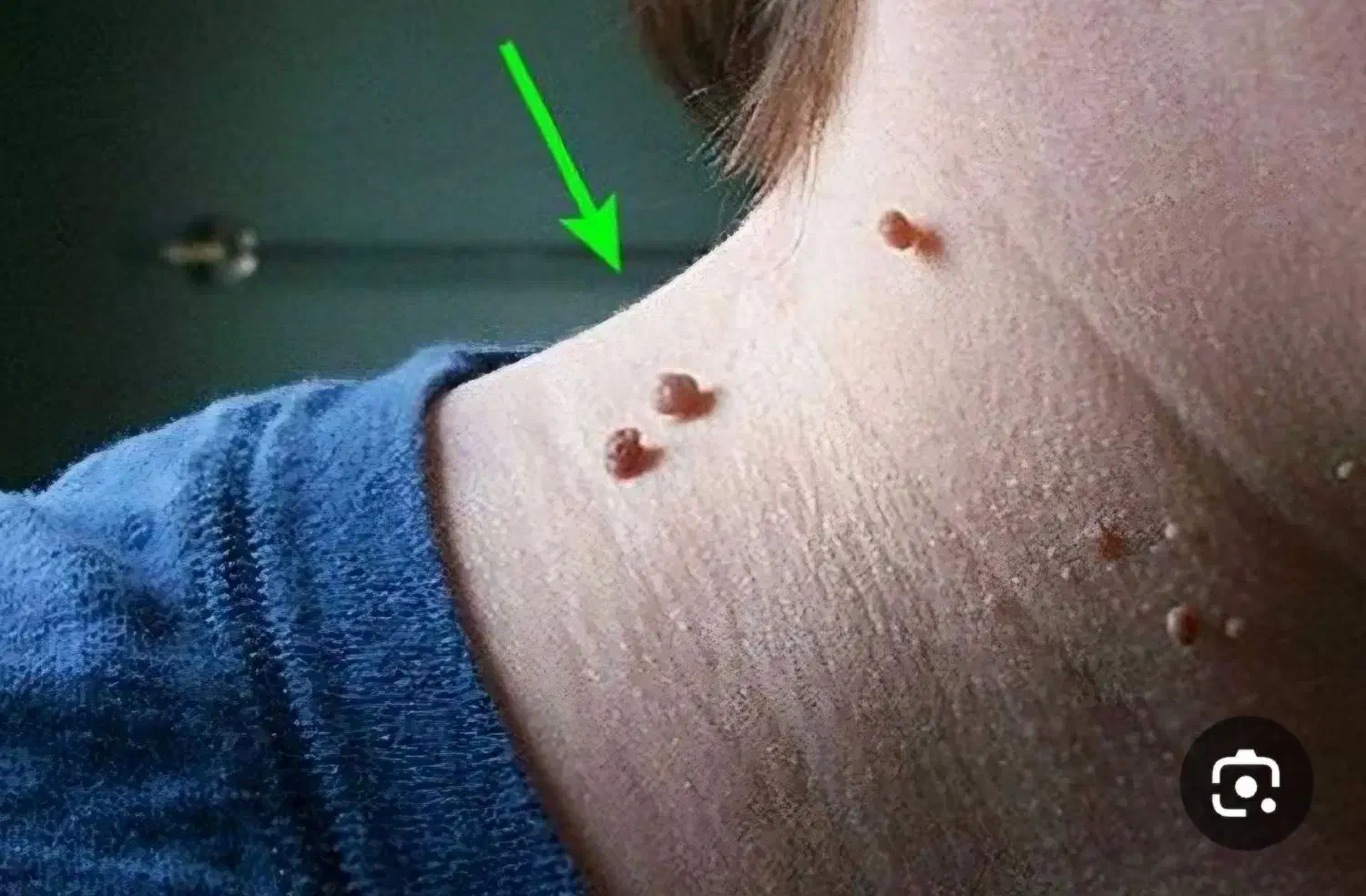 حذف کامل زگیل بدن|آرایشی، بهداشتی، درمانی|قم, سالاریه|دیوار