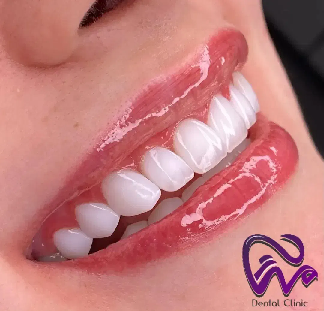 کامپوزیت دندان لبه شیشه ای فکی ۱۰ با اقساط بلندمدت|خدمات آرایشگری و زیبایی|تهران, تجریش|دیوار