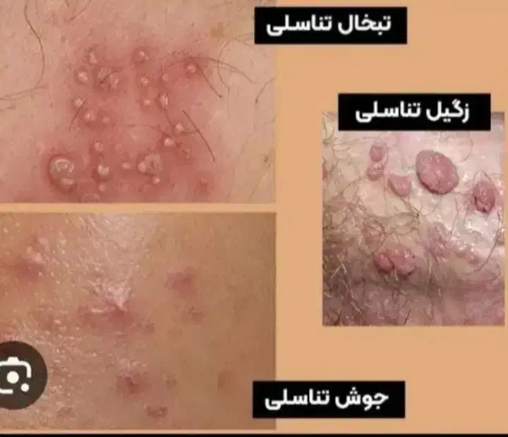 بهبود زگیل تناسلی|آرایشی، بهداشتی، درمانی|کرج, گلشهر|دیوار