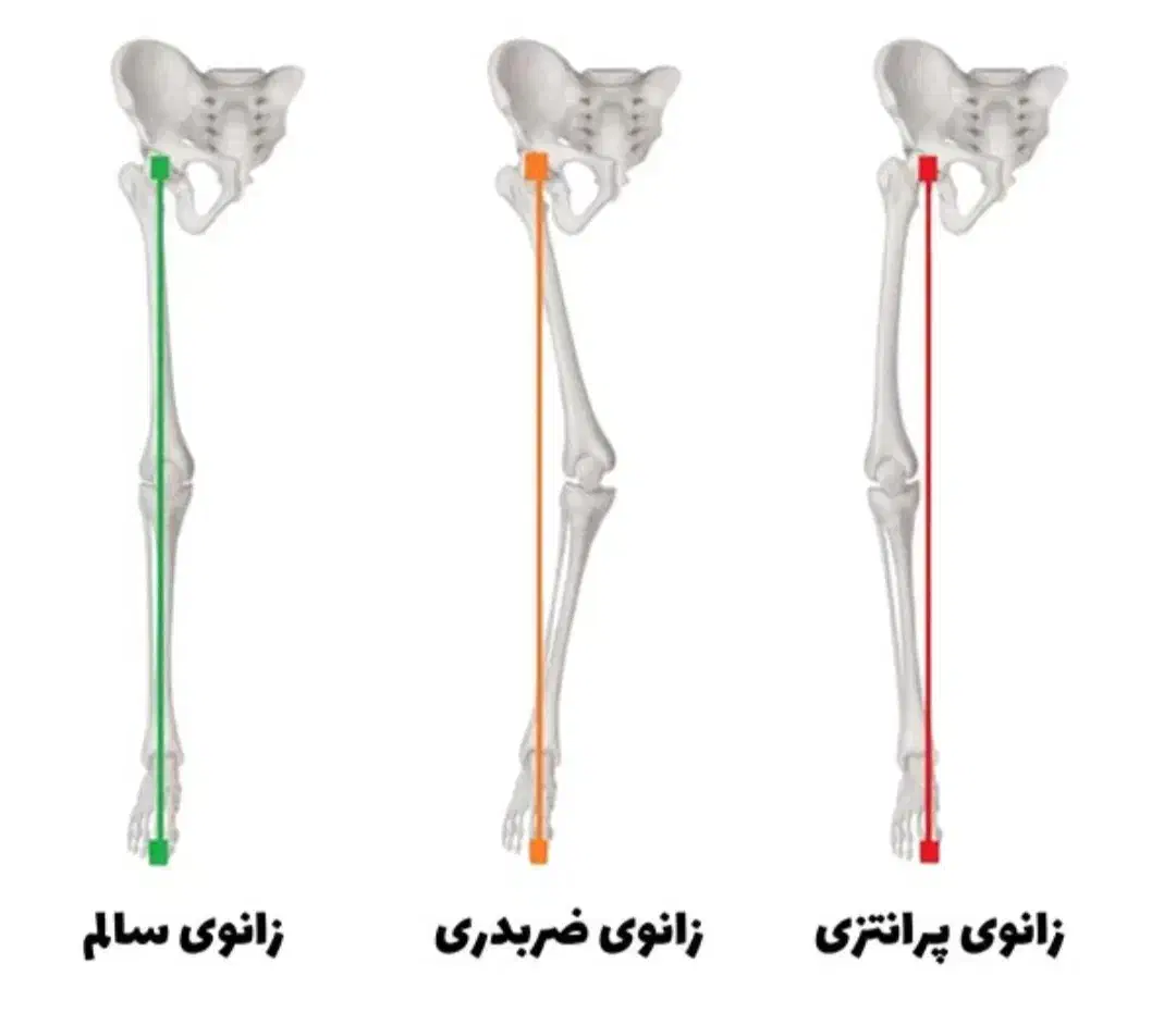 کلینیک تخصصی بهبود غیرجراحی انحرافات زانو|خدمات آرایشگری و زیبایی|بهار, |دیوار