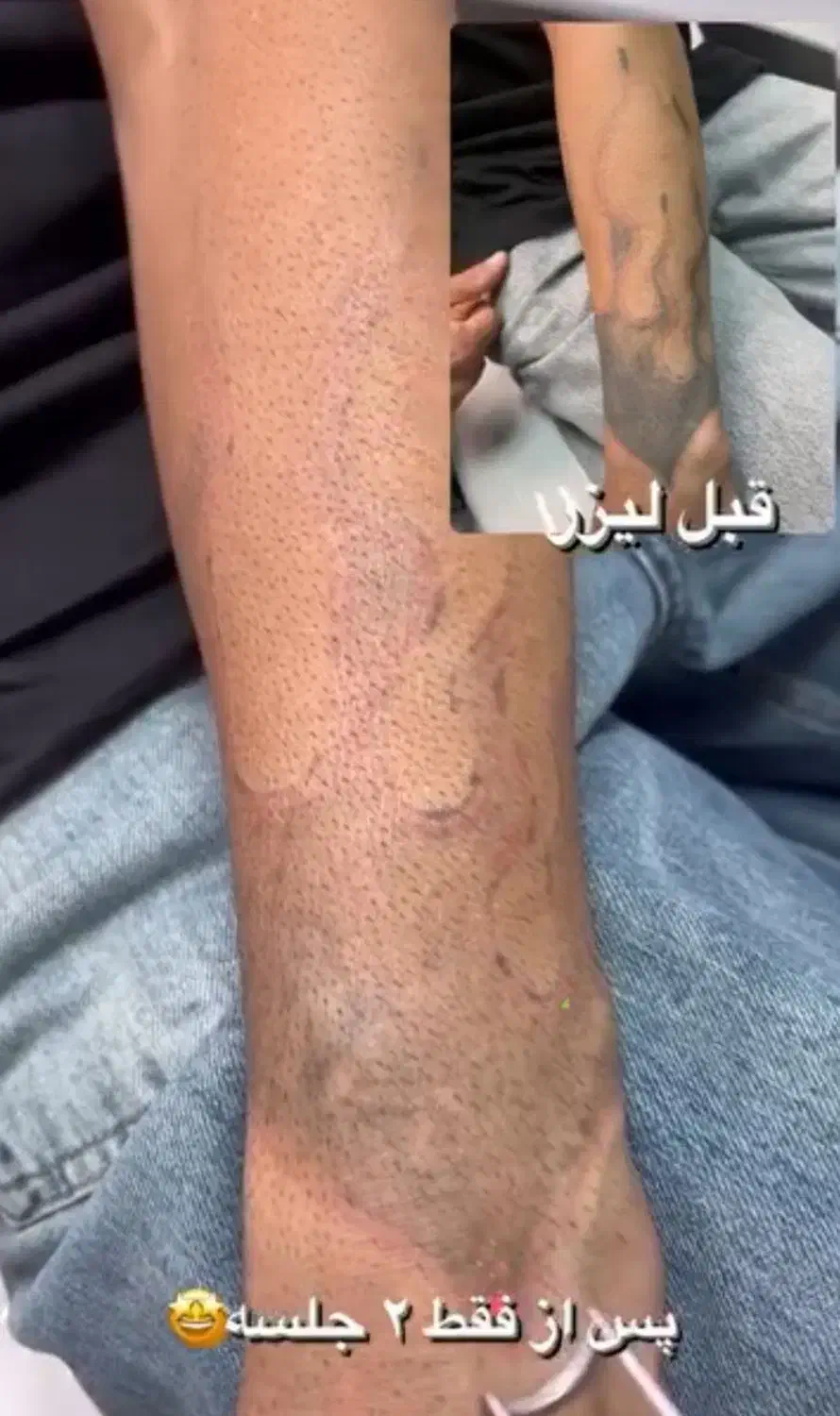 لیزر تتو ،ریمو،مربن تراپی ،خالبرداری|خدمات آرایشگری و زیبایی|شیراز, قصرالدشت|دیوار